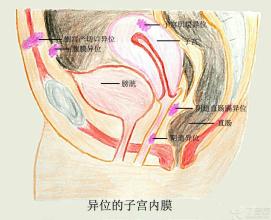 子宫内膜异位症会不会造成流产