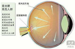 这些人易得青光眼 低眼压性青光眼如何治疗