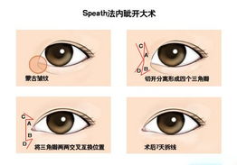4种常规开眼角术 快速变明眸大眼 