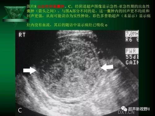 阴道超声检查规范鉴别诊断,超人必看