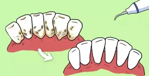 为什么洗牙的时候会牙齿酸痛 五大缓解小秘诀赶紧拿走
