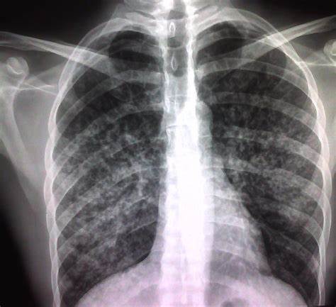 有人说肺结核很危险,有这么严重吗 肺结核对健康有哪些危害