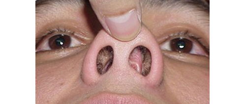 鼻息肉与正常鼻腔图图片