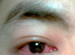 红眼病传染吗？红眼病会传染吗