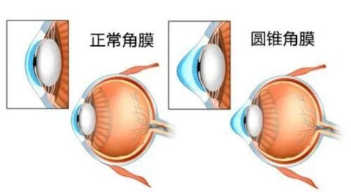 圆锥角膜病患福音 上海这项新研究有望提供更安全有效的策略