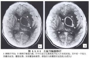 脑脓肿穿刺 吸引术