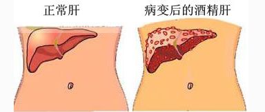 酒精肝，酒精肝是症状是么样的，要是有酒精肝了怎么办才好