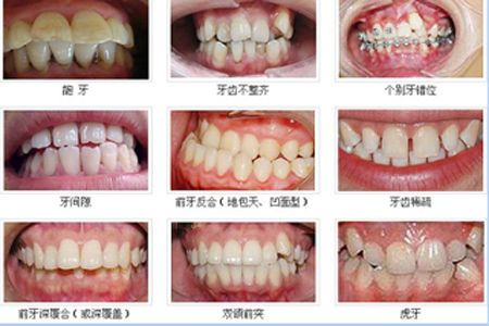 成年人做牙齿矫正需要多长时间,大概多少钱