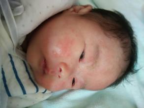 新生儿湿疹引发的原因及护理办法 如何缓解宝宝湿疹