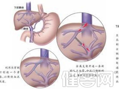 腹水的发病机制 