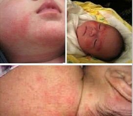 婴儿湿疹在中医里面怎么治疗,婴儿湿疹中医治疗有什么好的方法呀？
