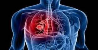 肺癌晚期究竟有多痛苦 死前都有这五大症状 
