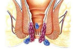 肛门脓肿