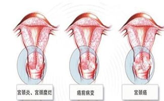 宫颈糜烂症状 大盘点