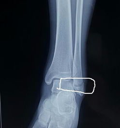 有骨伤科的么,脚踝骨折了,医生就打了石膏就好了 看CT吧 