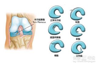 半月板损伤膝盖发软怎么办啊