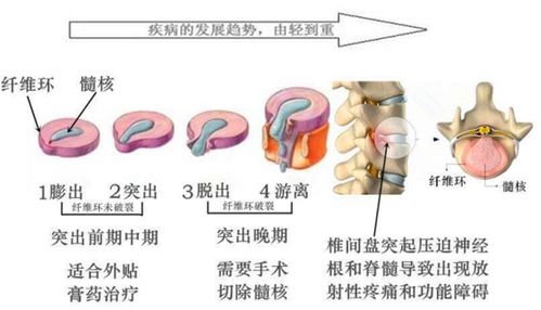 盲目治疗,带你认清治疗腰椎间盘突出的四大误区