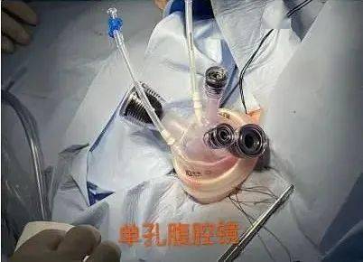 齐医附属三院妇一科成功开展单孔腹腔镜微创手术