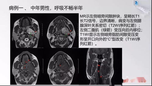 咽旁间隙病变定位与常见肿瘤性病变影像诊断