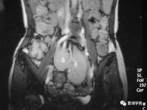 肾脏先天发育异常影像学诊断