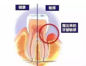 看了这篇文章,不要再问洗牙好不好了