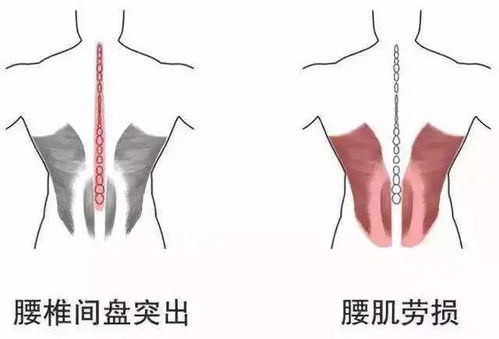 腰椎间盘突出症和腰肌劳损,你还傻傻分不清楚吗