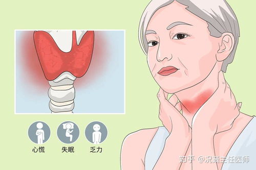 治甲状腺结节的偏方