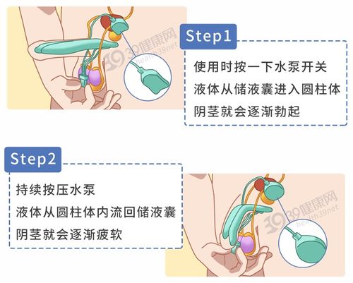 植入 人造丁丁 揭秘 阴茎起搏器的效果如何 哪些患者能用