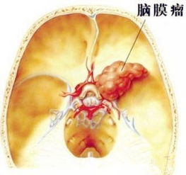 关于脑肿瘤的良恶性这几个问题很重要