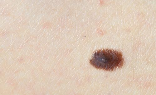体内有癌,皮肤先知 当身体出现2处发黑,可能是癌症来临的信号 
