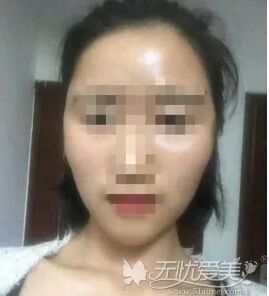 上上相如何修复脂肪填充失败 图片欣赏中心 急不急图文 Jpjww Com