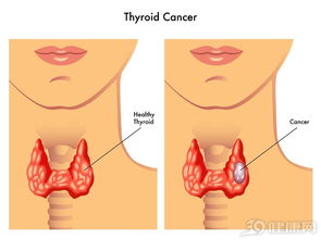 得了甲状腺癌,要手术切除吗 这几类情况,没得商量