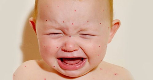 婴儿湿疹的症状(婴儿湿疹症状有哪些)