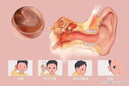 阳康 后,出现耳鸣 耳闷 听力下降,警惕分泌性中耳炎