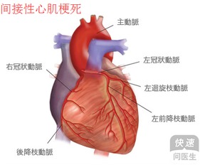 间接性心肌梗死是什么