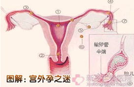 宫外孕早期症状，宫外孕早期症状有哪些