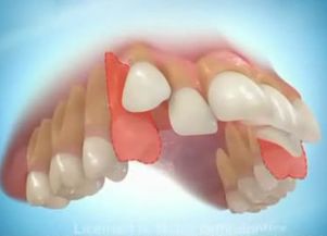 牙齿矫正需要拔牙吗拔牙会有什么危害吗