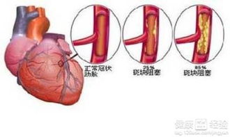 冠心病伴发心绞疼保守疗法好还是介入治疗好