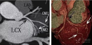  冠状动脉lcx是什么,了解冠状动脉LCX:重要性和功能 钱包应用