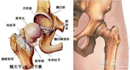 股骨头坏死是什么引起的(股骨头坏死是什么引起的呢)