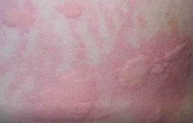 丘疹性荨麻疹有什么症状