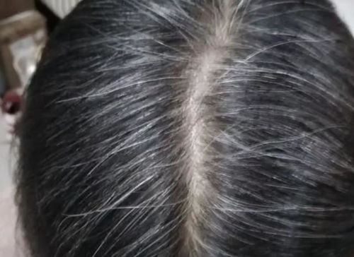 哈佛大学研究 白头发多的人不容易患上癌症 这是真的吗