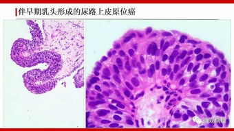 膀胱尿路上皮肿瘤诊断的一些困惑