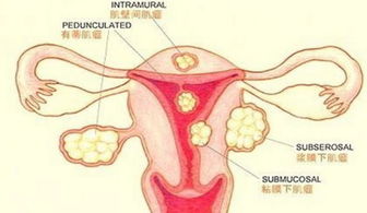 子宫肌瘤的饮食，子宫肌瘤的饮食有哪些