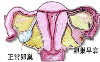 卵巢早衰怎么治疗效果好 北京华博医院专家告诉你
