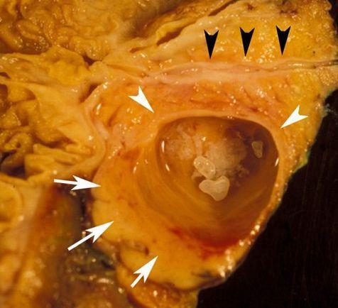 胰腺真性囊肿是怎么回事