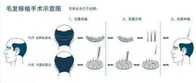 胡须种植后会自然吗