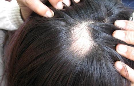 方济生发 斑秃诱因众多,尚无特效药,治疗前注意先排查诱因很重要