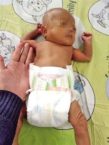 重庆一新生女婴早产仅0.8公斤 面临各种难题 