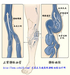 引起下肢溃疡的病因